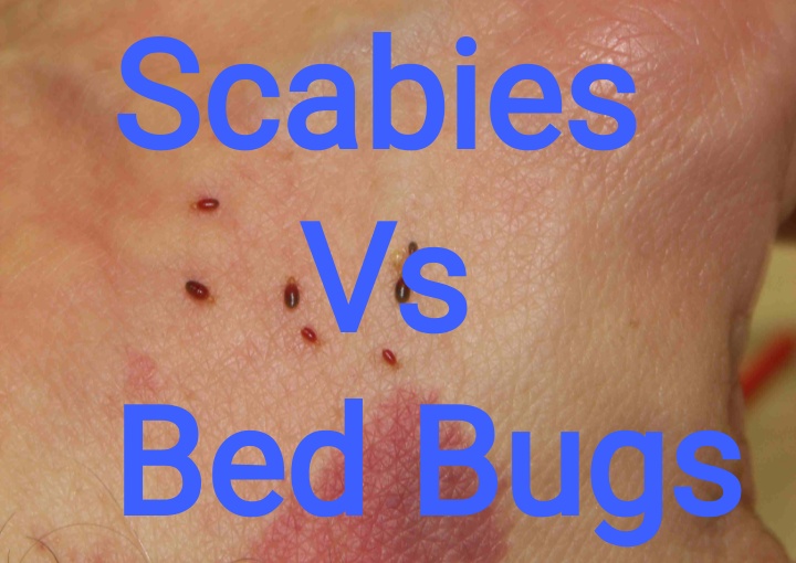 Bed Bugs Vs Scabies Renew Physical Therapy