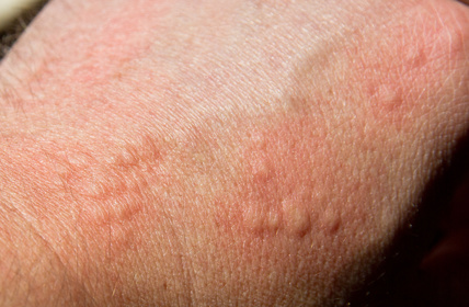 SCABIES VS BED BUGS bites