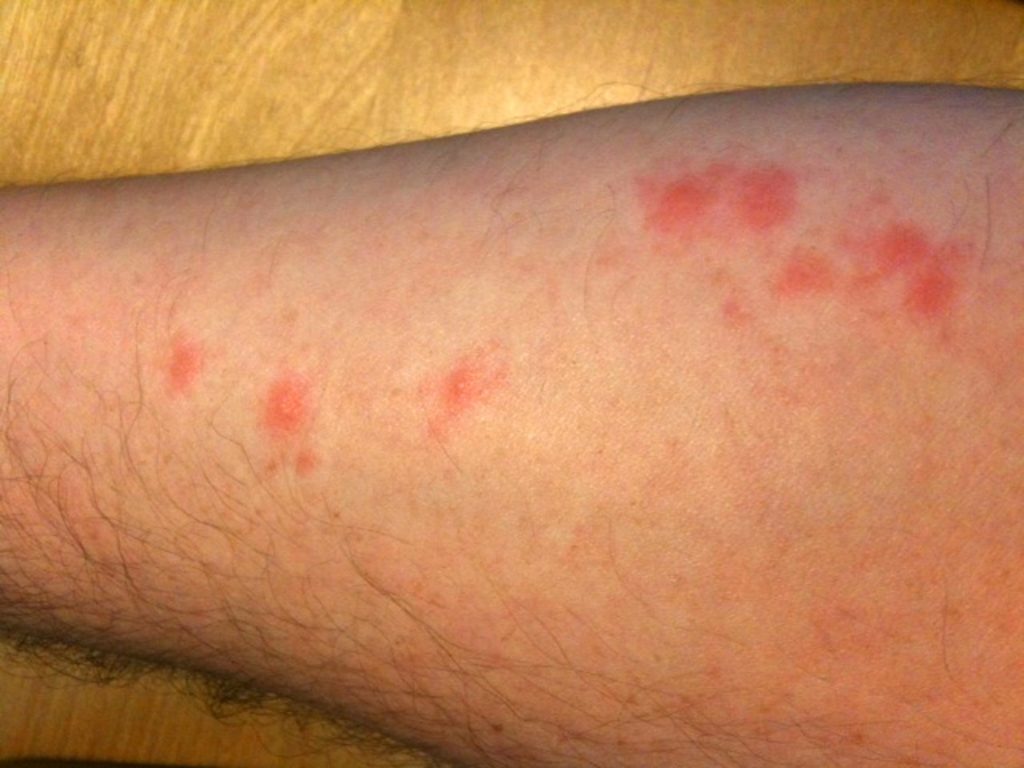 Signs of gnats bite